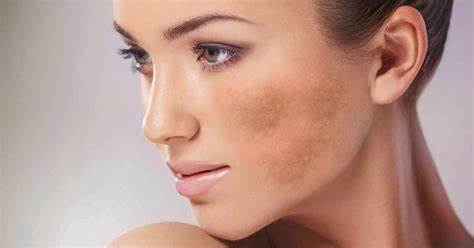 Melasma: curiosidades e dicas de tratamento