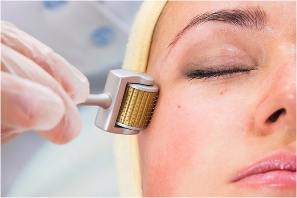 Microagulhamento: Um Tratamento Eficaz para Rugas, Cicatrizes e Estrias